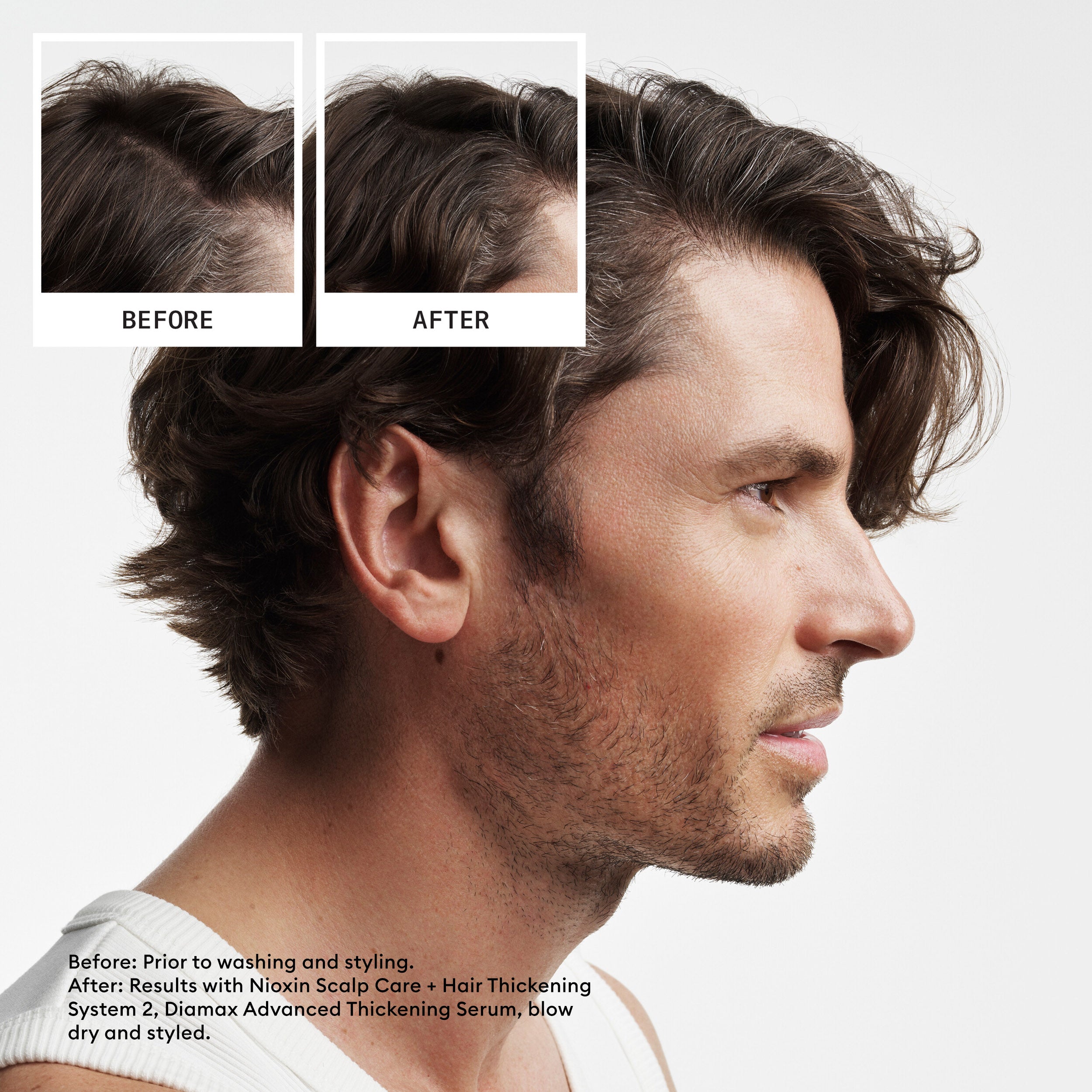 Nioxin Scalp  + Hair Thickening System 2 - Includes Shampoo, Conditioner and Scalp Treatment